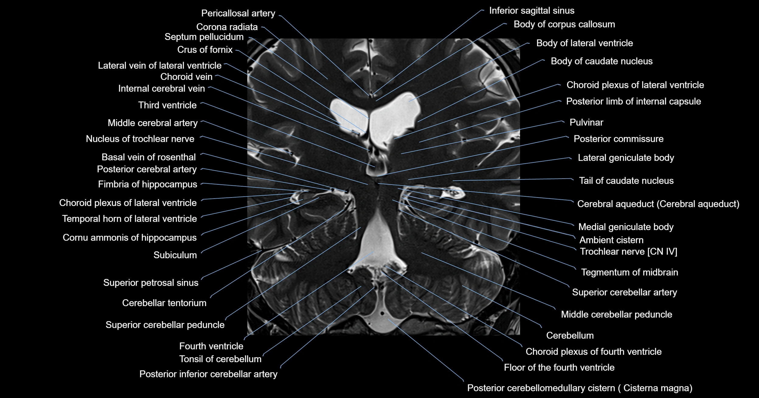 MRI brainstem & basal ganglia anatomy labelled 3T MRI images -img-00001-00028.webp
